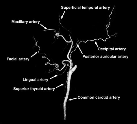 External Carotid Artery Branches Angiogram