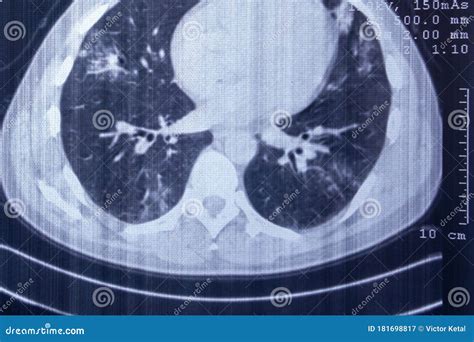 X-ray of Pneumonia-affected Lungs. CT Scan Stock Image - Image of anatomy, heart: 181698817