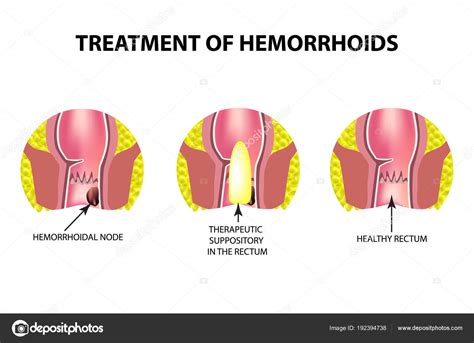 Using Suppositories For Hemorrhoids