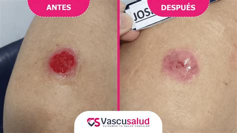 Cicatrización completa de la quemadura de 2do grado en el hombro de ...