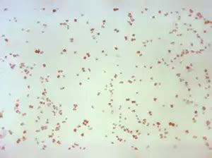 What is syphilis disease? Why is it rising in newborns? Check treatment ...