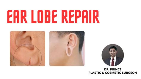 Restoring Symmetry: A Comprehensive Guide to Ear Lobe Repair by Dr. Prince - topplasticsurgery
