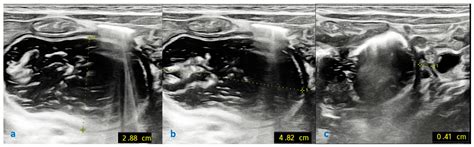 Tips and Tricks in the Laparoscopic Treatment of Type I Duodenal ...