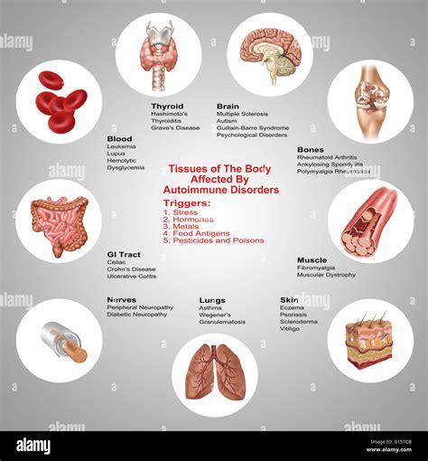 Autoimmune diseases can be triggered by the following: stress, hormones, metal, food antigens ...