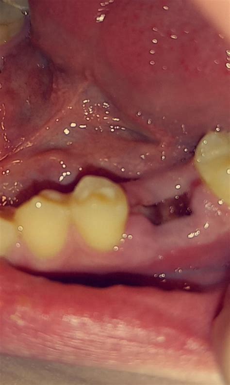 Image result for Healed Tooth Extraction