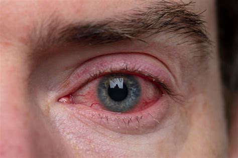 What is Conjunctivitis? Know Its Types, Causes, and Treatment