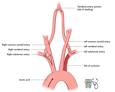 NBME Medicine Form 6 - Answers & Explanations | Vertebral artery ...