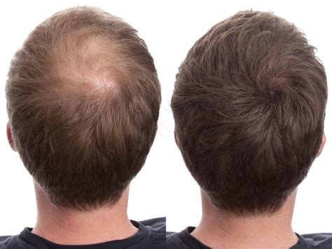 hair fibers