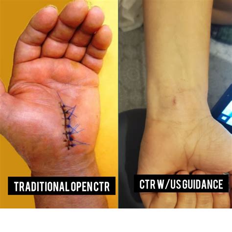 How much does Carpal Tunnel surgery cost? - Florida Carpel Tunnel ...