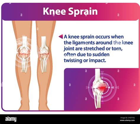 Illustration of knee sprain symptoms and causes Stock Vector Image ...