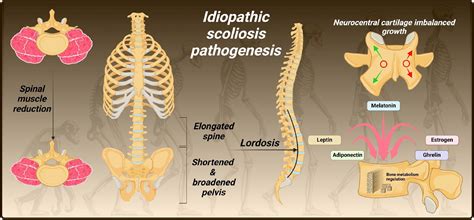 Genetics and pathogenesis of scoliosis - North American Spine Society ...