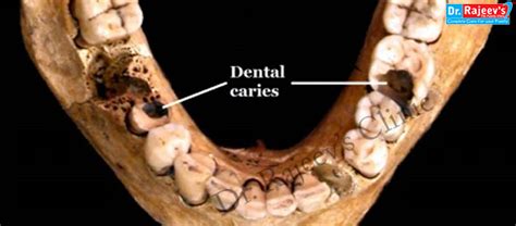 homeopathic treatment for Dental caries in homeopathy, treatment of ...