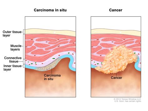 3 Types of Tumors: Is Cancer a Death Sentence?