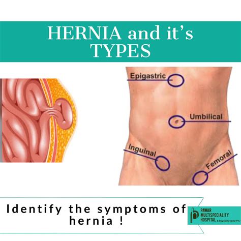 What Does A Belly Button Hernia Look Like at Mariam Mountgarrett blog