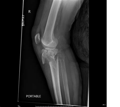 Tibial Plateau Fractures - Trauma - Orthobullets