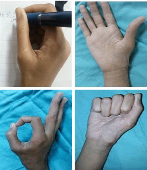 Image result for Normal Hand