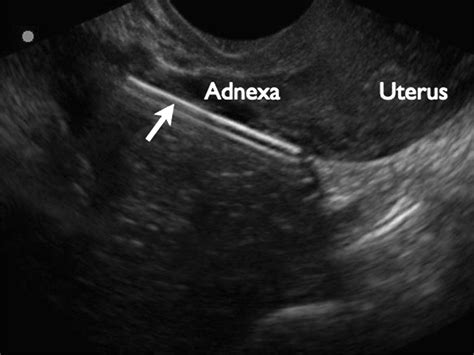Perforated Uterus with Displacement of Intrauterine Device - Journal of Emergency Medicine