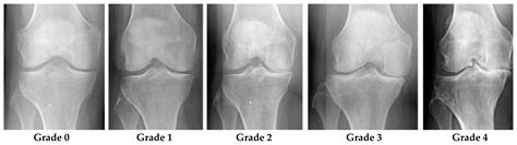 Identifying Severity Grading of Knee Osteoarthritis from X-ray Images Using an Efficient Mixture ...
