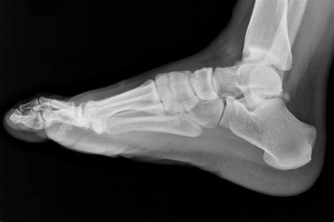 Ball Of Foot X Ray at Sherlyn Weyer blog