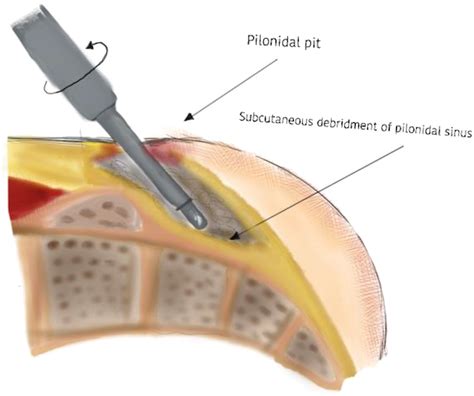 Management of Pilonidal Disease and Hidradenitis Suppurativa - Surgical Clinics