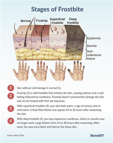 Stages Of Frostbite