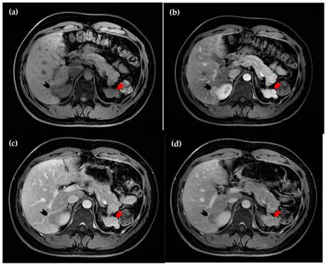 Imaging Findings of a Rare Intrahepatic Splenosis, Mimicking Hepatic Tumor