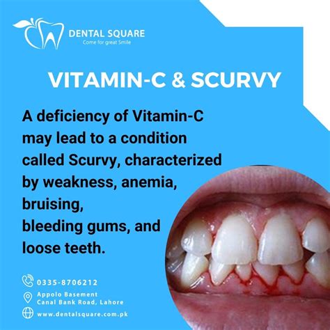 Vitamin C Deficiency Gums Gum Disease And Bad Breath Treatment In