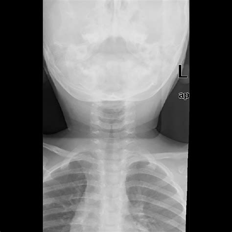 Stridor in the Infant and Young Child | 2017-04-06 |… | Clinician.com