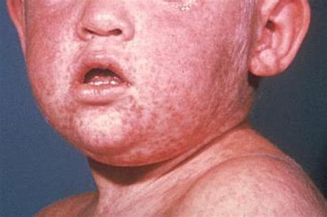 Philadelphia measles outbreak is over, health authorities say