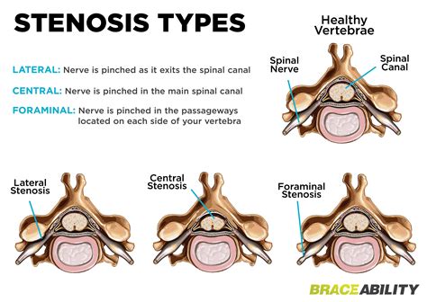 The Difference Between Foraminal, Central, & Lateral Recess Stenosis in Your Spinal Cord ...