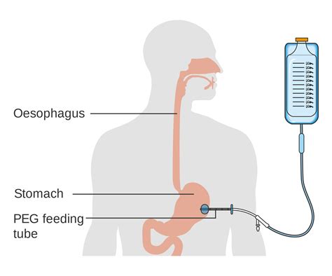 PEG Feeding Tubes - Indications and Management
