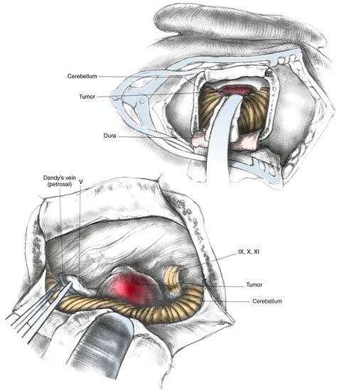 Retrosigmoid Approach to Tumors of the Cerebellopontine Angle - Clinical Tree