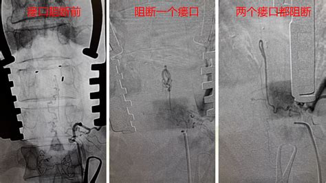 李东波教授：复合手术治疗髓周动静脉瘘1例