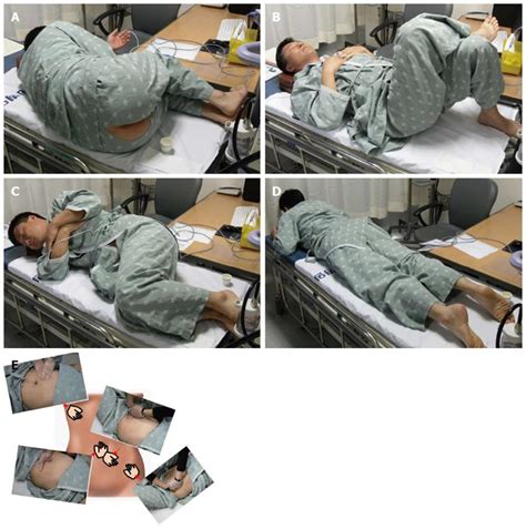 A Colonoscopy Procedure 的图像结果