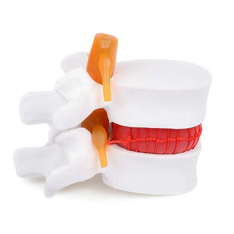 Anatomical Herniated Lumbar Vertebrae Disc Prolapse Model Human Medical ...