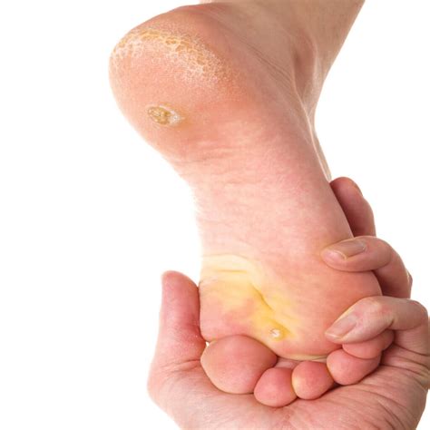 Corns and Calluses - Brampton Foot Clinic