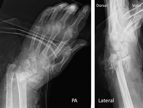 Image result for Open Reduction Distal Radius Fracture