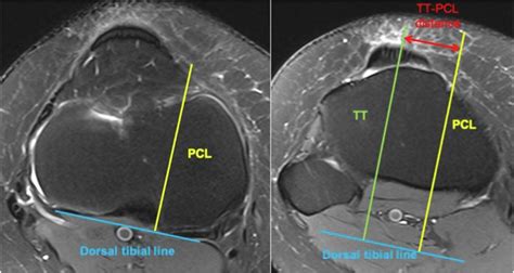 Patellar Tilt and Patellar Tendon–Trochlear Groove Angle Present the Optimum Magnetic Resonance ...