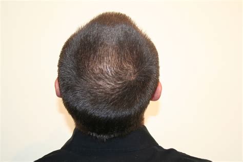 On Stage Hair Design: Nioxin/Rogaine: Does it Really Work?