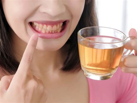 Image result for Teeth Staining Causes