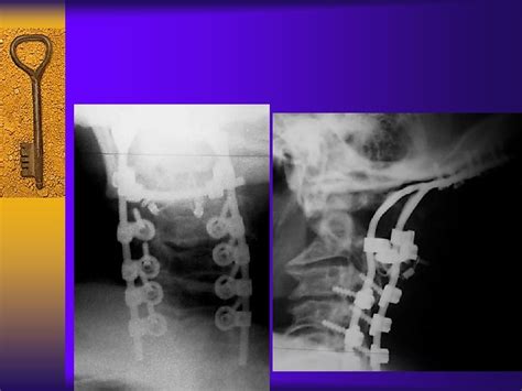 Cervical Spine Surgery For Patients with Rheumatoid Arthritis