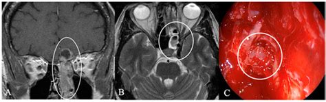 Distinctive Characteristics of Rare Sellar Lesions Mimicking Pituitary ...