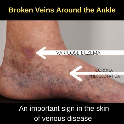 The Skin is Affected by Bad Leg Veins | The VeinCare Centre