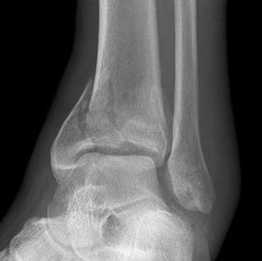 Imaging in Ankle Fractures: Overview, Radiography, Computed Tomography