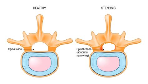 Lumbar Spinal Stenosis Specialists | Pain & Spine Specialists