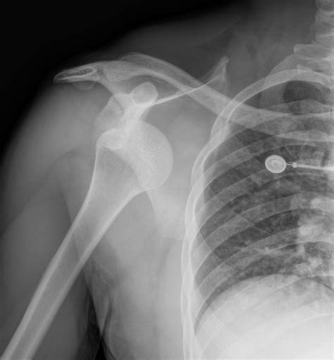 Partial Shoulder Dislocation X Ray at Janice Hogan blog