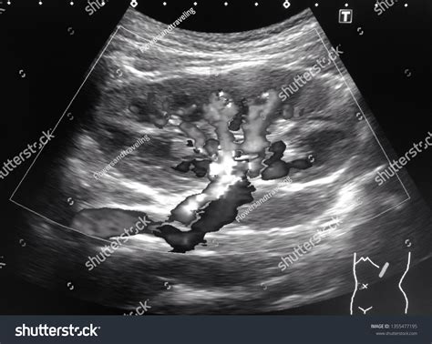 Monochrome Image Kidney Ultrasound Renal Artery Stock Photo 1355477195 | Shutterstock