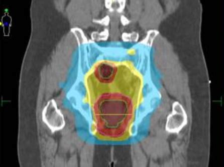 Skipping Radiation before Rectal Cancer Surgery - NCI