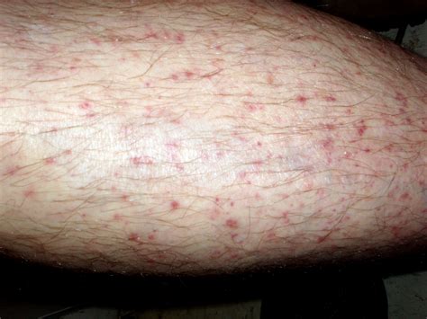 Itchy Lupus Rash On Legs: Identification – WAEXX