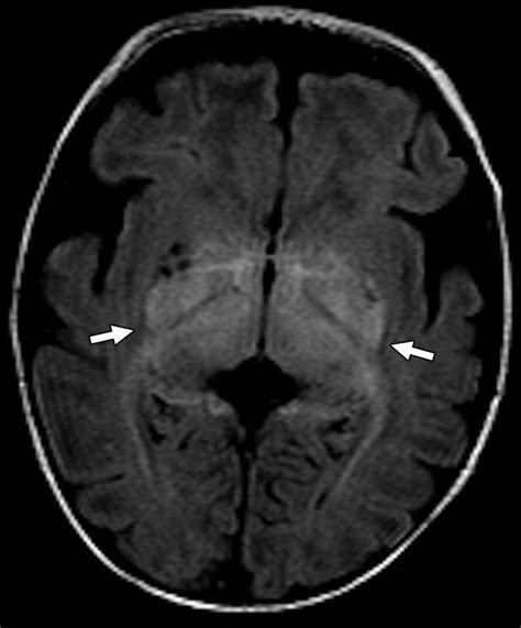 Lateral Geniculate Nucleus Mri